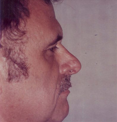 Rhinoplasty-01 | After Rhinoplasty