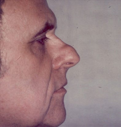 Rhinoplasty-01 | Before Rhinoplasty
