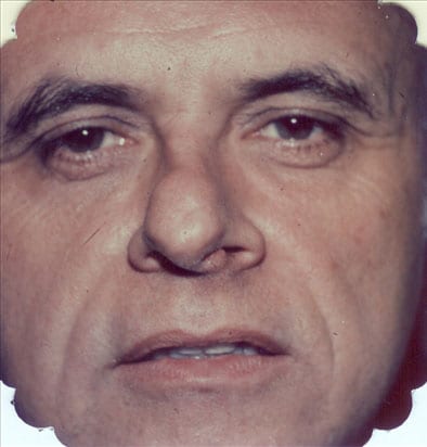 Rhinoplasty-01 | Before Rhinoplasty 2