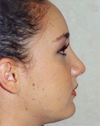 Rhinoplasty-02 | After Rhinoplasty