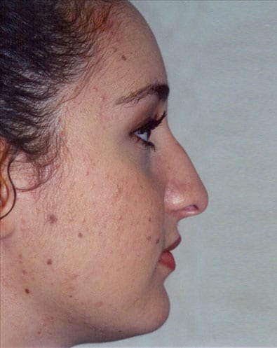 Rhinoplasty-02 | Before Rhinoplasty