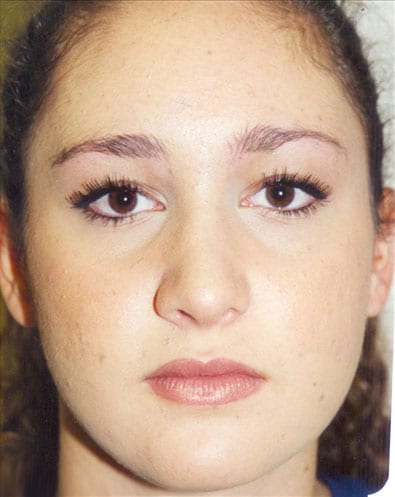 Rhinoplasty-02 | After Rhinoplasty 2