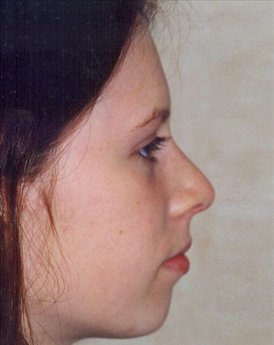 Rhinoplasty-03 | After Rhinoplasty