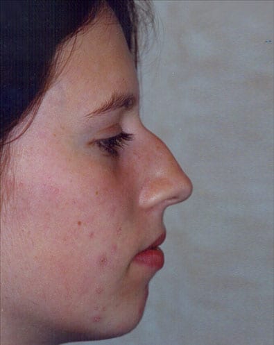 Rhinoplasty-03 | Before Rhinoplasty