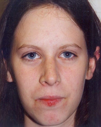 Rhinoplasty-03 | After Rhinoplasty 2