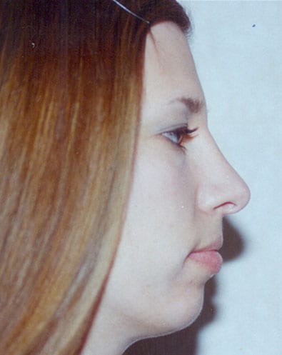 Rhinoplasty-04 | After Rhinoplasty