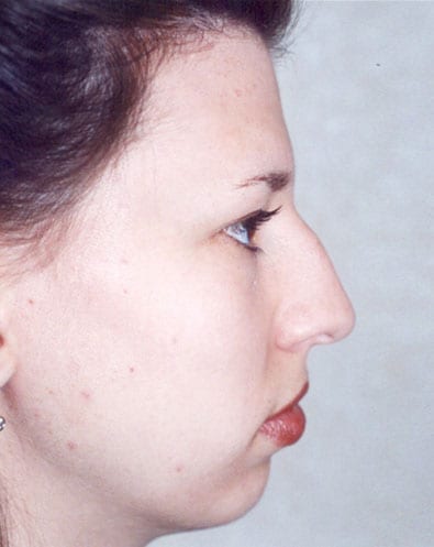 Rhinoplasty-04 | Before Rhinoplasty