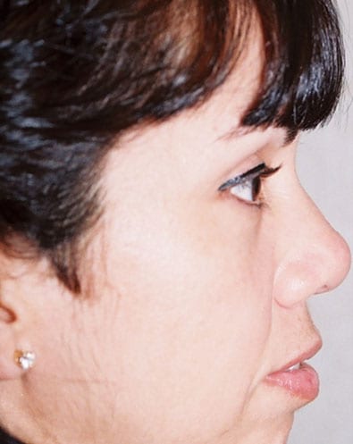 Rhinoplasty-05 | After Rhinoplasty