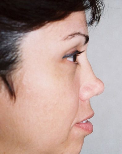 Rhinoplasty-05 | Before Rhinoplasty