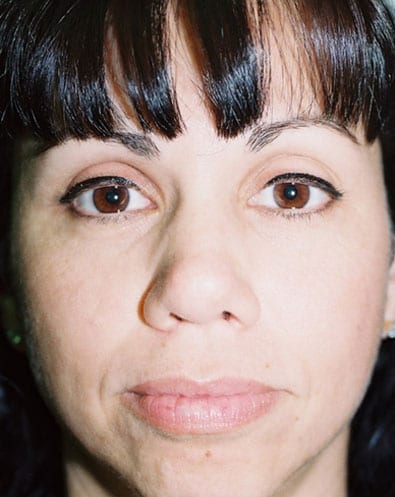 Rhinoplasty-05 | After Rhinoplasty 2