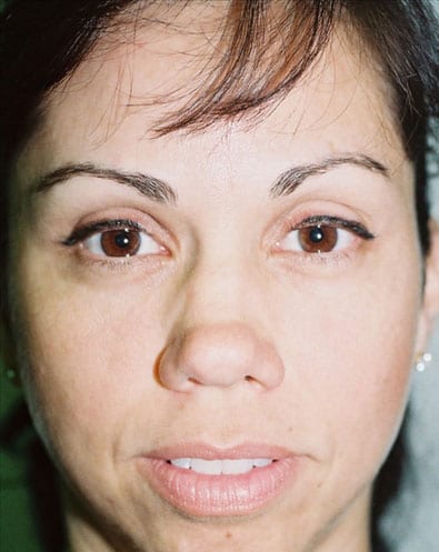 Rhinoplasty-05 | Before Rhinoplasty 2