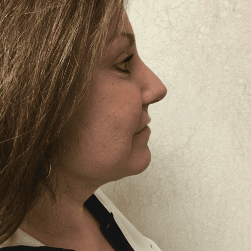 Rhinoplasty-06 | After Rhinoplasty