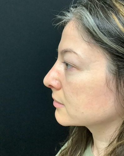 Rhinoplasty-07 | After Rhinoplasty