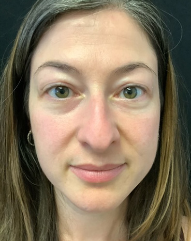 Rhinoplasty-07 | Before Rhinoplasty 2