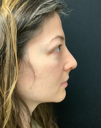 Rhinoplasty-07 | After Rhinoplasty 3