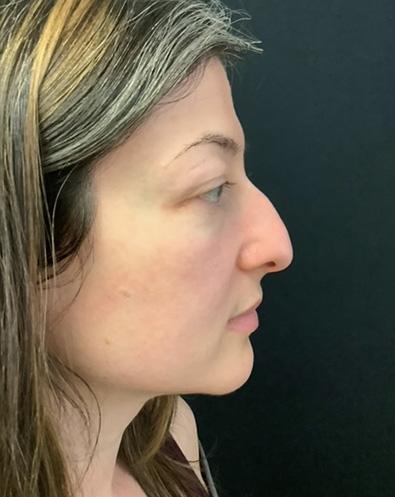 Rhinoplasty-07 | Before Rhinoplasty 3