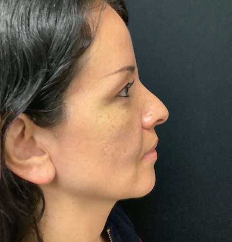 Rhinoplasty-08 | Before Rhinoplasty