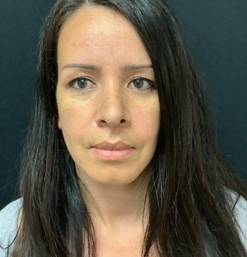 Rhinoplasty-08 | After Rhinoplasty 2