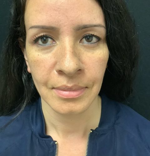 Rhinoplasty-08 | Before Rhinoplasty 2