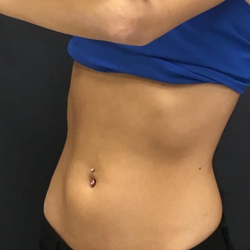 Sculpsure-01 | After Sculpsure