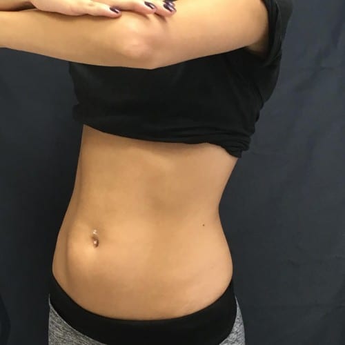 Sculpsure-01 | Before Sculpsure