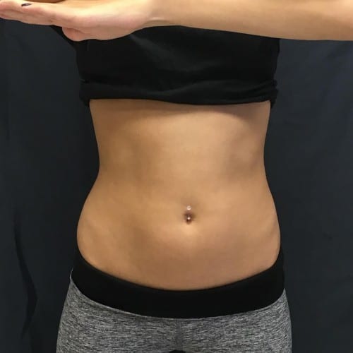 Sculpsure-01 | Before Sculpsure 2