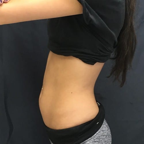 Sculpsure-01 | Before Sculpsure 3