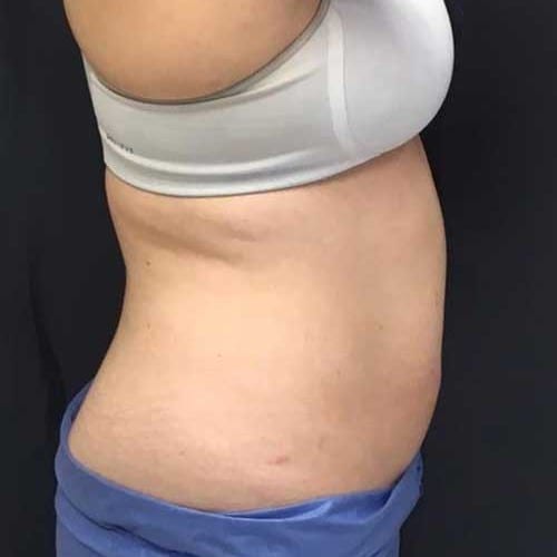 Sculpsure-03 | Before Sculpsure