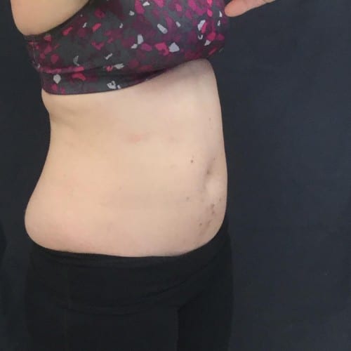 Sculpsure-03 | After Sculpsure 3