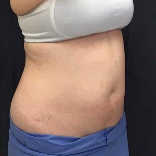 Sculpsure-03 | Before Sculpsure 3