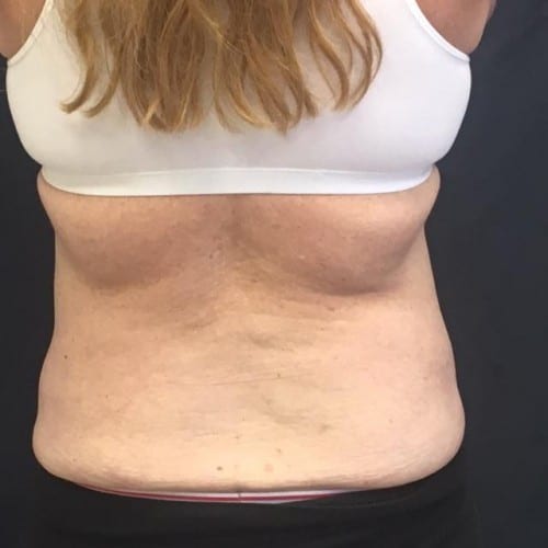 Sculpsure-04 | Before Sculpsure