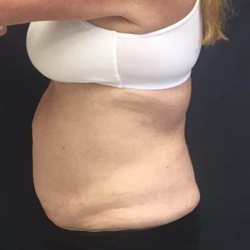 Sculpsure-04 | Before Sculpsure 2